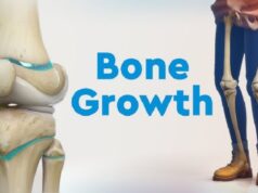 Designing for Bone Growth: Dr. Larry Davidson Discusses Porosity and Osseointegration in Modern Spine Implants Bone Growth